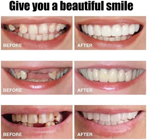 Лажни заби горните и долните заби на забите покриваат заби за белење на заби на заби удобни заби ортодонт