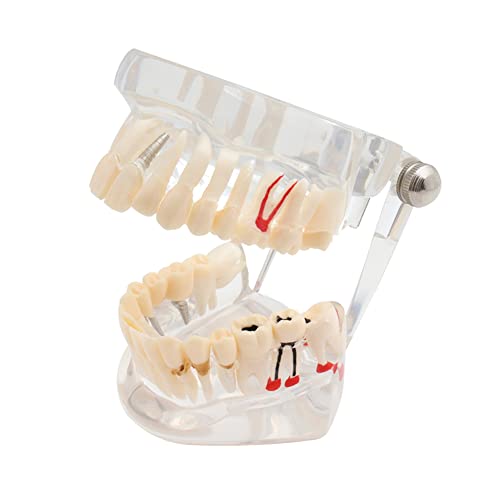 Модел на заби Транспарентен модел на заби на типодонт, отстранлив модел на заби