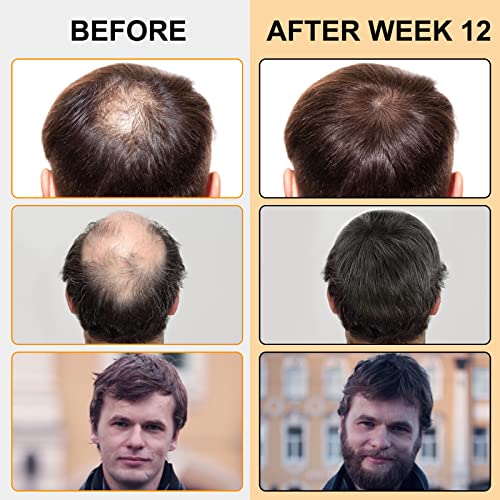 5% миноксидил пена за опаѓање на косата и прераспределување на косата - миноксидил 5% серум за раст на косата со биотин третман на ретроспектива